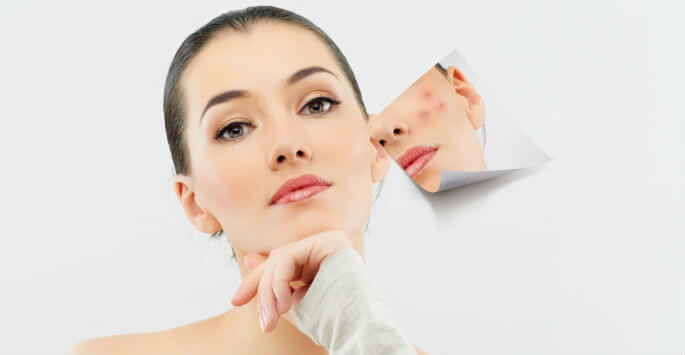 Acne Treatment with Anti-Acne Facials - Orlando FL - Dr. Jeannette ...