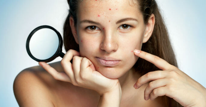 Cysts and Acne
